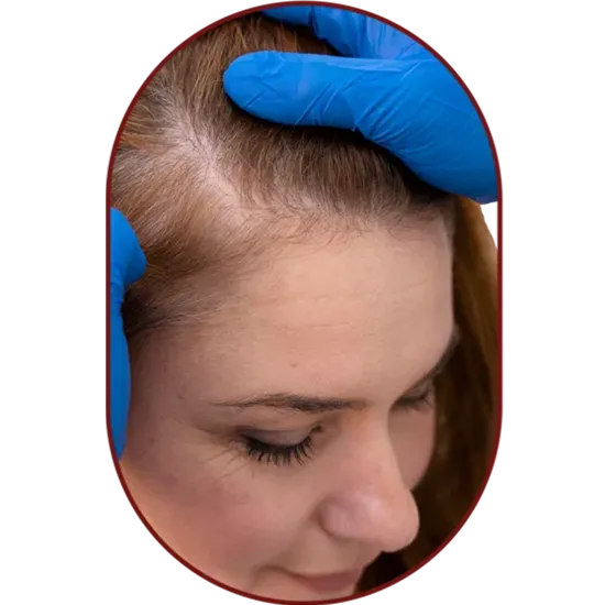 Queda de Cabelo